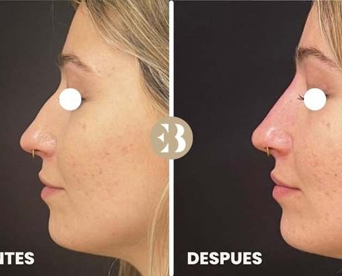 eb antes y despues rinomodelacion