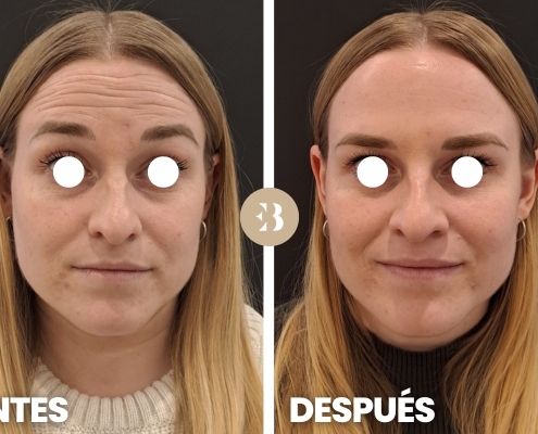 Eliminar arrugas frente