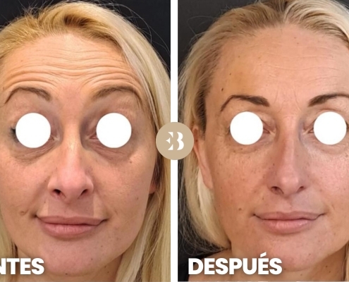 Eliminar arrugas frente