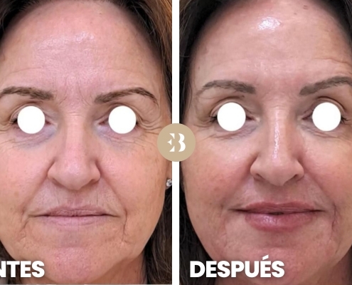 Eliminar arrugas frente