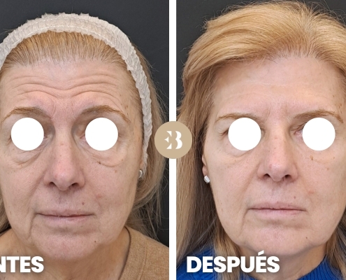 Eliminar arrugas frente