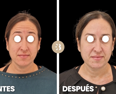 Eliminar arrugas frente