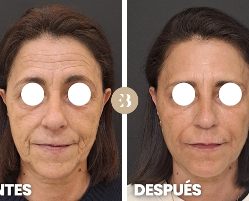 Eliminar arrugas frente