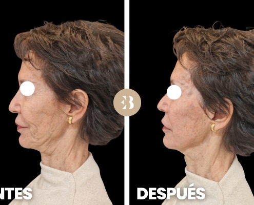 Eliminar arrugas frente